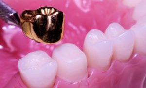 Цельнометаллическая зубная коронка